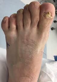 Последние твиты от foot (@foot). When An Adult Presents With Postaxial Polydactyly Of The Foot Podiatry Today
