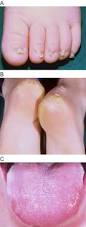 Image result for Koilonychia feet