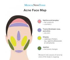 acne face map causes of breakouts