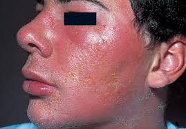 Dermatita numulara generalitatidermatita numulara eczematoasa eczema numulara sau dermatita numulara este. EsenÈialul Despre Dermatite Èi Eczeme Health Beauty Online Journal