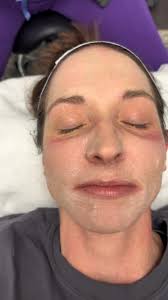 Before ➡️ During ➡️ After, ZO® 3-Step Peel ✨, Then we followed up with:,  Before ➡️ During ➡️ After, Microneedling + ZO® 3-Step Peel , Now the  healing begins—stay tuned to follow the day-to-day ...