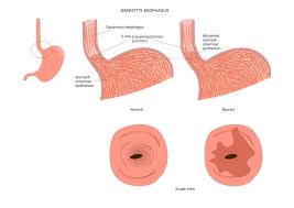Image result for esophagus