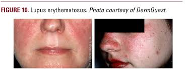 Image result for demodex rosacea
