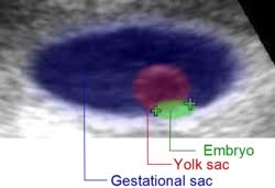 Gestational Sac Wikipedia