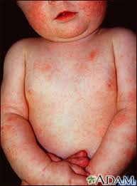 Image result for Atopic eczema atopic dermatitis