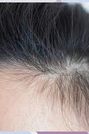 How To Treat Broken Hairs Along Your Hairline Glamour Uk