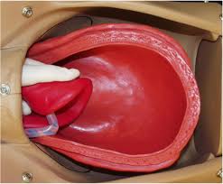 Image result for Retained Placenta