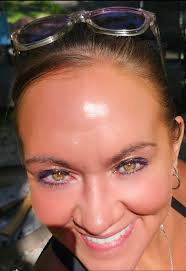 Central Heterochromia