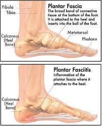 What Is Plantar Fasciitis Plantar Fasciitis Planter Fasciitis Treatment Plantar Fasciitis Exercises