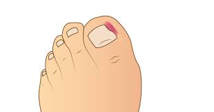 Estos Son Los 5 Problemas Mas Comunes En Las Unas De Los Pies Ceapie