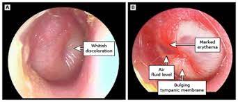 Ear Infections In Adults And Children Brevard Physicians Associates