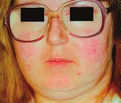 Oral and Maxillofacial Diseases