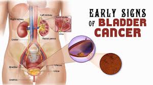 Early diagnosis and therapeutic intervention are instrumental for maximizing successful outcomes. Healthspectra Early Signs Of Bladder Cancer Facebook