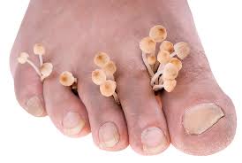 Athlete S Foot But I M Not Even An Athlete Graber Emmy Dermboston Com