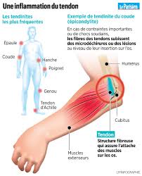 Symptômes et traitement de la tendinite chronique des fibulaires à lyon. Comment Se Debarrasser D Une Tendinite Le Parisien