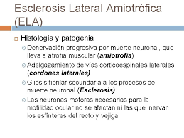 La esclerosis lateral amiotrófica (ela) es una enfermedad neurodegenerativa rápidamente progresiva. Enfermedades De La Neurona Motora Superior E Inferior