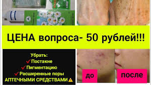 как убрать рубцы от прыщей на лице народные средства Ubrat Pigmentnye Pyatna Postakne Rasshirennye Pory Za 50 Rublej Alternativa Lazernoj Shlifovke Youtube Lechenie Akne Pyatna Temnye Pyatna