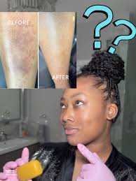 Effective Solutions for Hyperpigmentation: My Skin Transformation Story