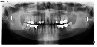 Image result for Tonsillolith