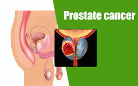 Others start adding up as the tumor becomes more extensive, especially after the disease spreads to distant organs. Warning Signs Of Prostate Cancer Health Vision