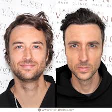 Ever wondered if you could regain your confidence with a restored hairline?  Just ask Johnny Mitchell! As the host of a popular true-crime podcast,  Johnny's on-screen presence matters. So when he decided