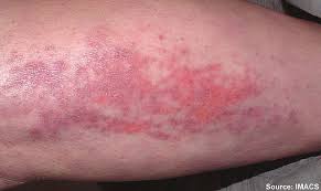 Image result for Dermatomyositis