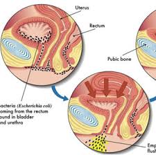 Urinary Tract Infection Uti Health Navigator Nz