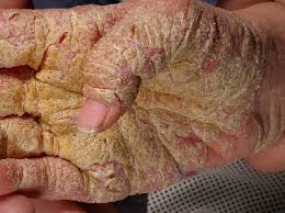 Image result for scabies norvegica