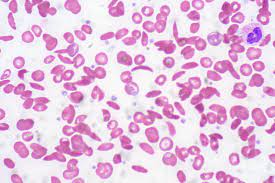 In sickle cell anemia, some red blood cells become deformed, so they look like sickles used to cut wheat. Sickle Cell Anemia Lecturio Online Medical Library