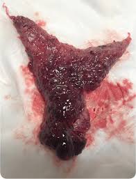 Decidua describes when the lining of the uterus undergoes changes from the influence of progesterone in preparation for pregnancy during the secretory phase of the menstrual cycle, dr. Fleshy Mass Passed Vaginally By A Young Woman Photo Quiz American Family Physician