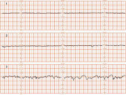 Intrapartum Fetal Heart Rate Assessment Obstetrical Complications Due To Pregnancy Williams Manual Of Pregnancy Complications 23 Ed