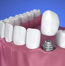 A Dental Crown Is A Natural Looking Cap Which Is Placed Over A Tooth Or Implant It Is Custom Made To Match Your Teeth An Dental Cosmetics Dental Crowns Dental