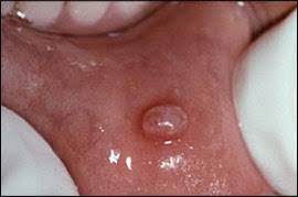 Plexiform fibroma sclerosing fibroma osseous fibroma buccal mucosa cancer buccal mucosa lump buccal mucosa lichen planus buccal mucosa ulcer. Common Oral Lesions Part Ii Masses And Neoplasia American Family Physician