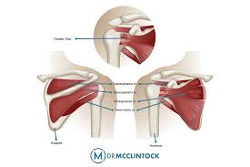 Image result for Rotator Cuff Injury