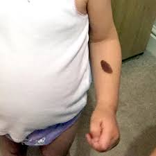 Birthmark On Leg Meaning In Hindi Birthmarks In Babies And Toddlers Babycenter India
