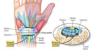 7 Early Warning Signs Of Carpal Tunnel Try These Strategies Before You Agree To Surgery With Images Carpal Tunnel Carpal Tunnel Syndrome Carple Tunnel Symptoms