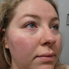 What are your tips to prevent wind burn?