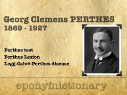 Image result for Perthes Test