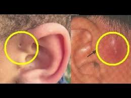 10 penyebab dan 6 cara ampuh mengatasi telinga berdengung. Hati Hati Jika Ada Lubang Kecil Di Telinga Bagian Atas Anda Youtube