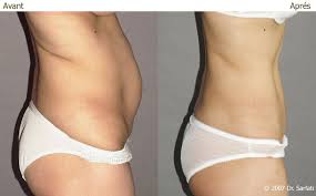 Accès direct à la bibliothèque (liens externes). Abdominoplastie Ou Plastie Abdominale Resultats Avant Apres