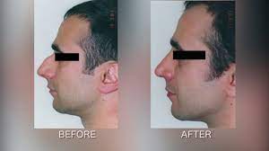 Scarlett johansson before and after nose job 2. Fixing Large Bump With Rhinoplasty Youtube