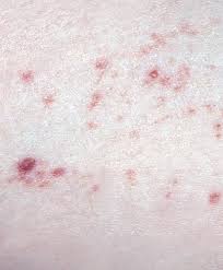 Small common skin growths, cherry angiomas look like flat or raised red spots, freckles or moles. Diagnosing Rashes Part 7 Purpuric Rashes Practice Nursing