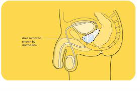 However, as with other types of cancer,. Management And Treatment Of Prostate Cancer Cancer Council Victoria
