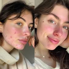 Experience the Benefits of Red Light Therapy with Kala Therapy