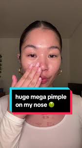 Dealing with Painful Mega Pimples: Acne Patch for Nose Crevice
