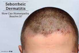 In cases where the rash is itchy, scratching can cause hair loss or make it worse. Seborrheic Dermatitis How Can Homeopathy Resolve It By Dr Kamal Madhav Lybrate