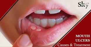 Image result for mouth ulcer on tongue)