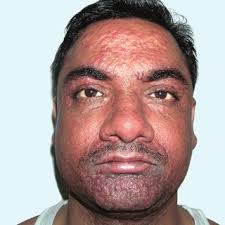 Resident analysis: household-level risk factors for visceral...