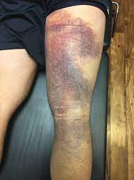 You may also experience bruising or discoloration along the back of your leg, as well as muscle weakness or. How To Treat A Hamstring Injury With Active Release Technique A R T 5280 Cryo
