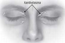 Image result for xanthelasma of eyelid